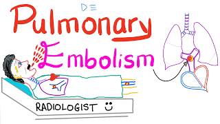 Pulmonary Embolism PE [upl. by Parsaye]