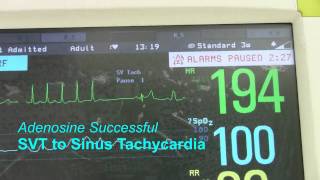 SVT or Supraventricular Tachycardia [upl. by Tolkan]