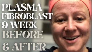 PLASMA FIBROBLAST BEFORE AND AFTER 9 Week Results  Plasma Pen At Home  Snow Skin Co [upl. by Enomaj]