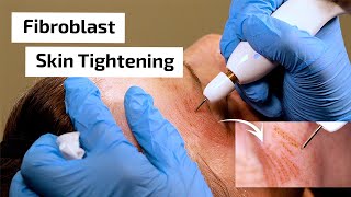 What is Fibroblast Skin Tightening  Prime Plasma [upl. by Anneirda]