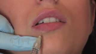 Lippenunterspritzung mit Juvederm Volbella  PULLMANN [upl. by Prouty]