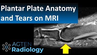 How to Assess Plantar Plate Anatomy and Tears on MRI [upl. by Namso616]