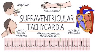 Understanding Supraventricular Tachycardia SVT [upl. by Marceau]