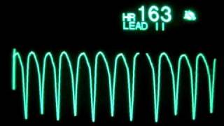 Ventricular Tachycardia [upl. by Atyekram]