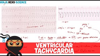 Tachycardia Teaching ACLS Algorithms [upl. by Tongue]