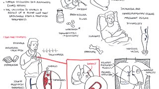 Pulmonary Embolism  Overview [upl. by Pulchia625]